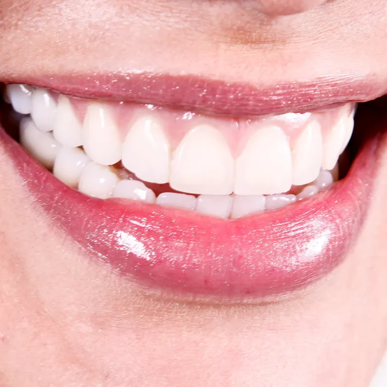تاثیرات مواد با خواص بازی بر ایمپلنت دندان