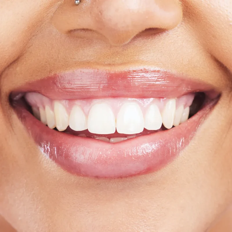 تاثیرات مواد با خواص اسیدی بر عصب کشی فوری دندان